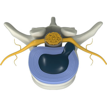 Spinal Decompression is applied to the spine